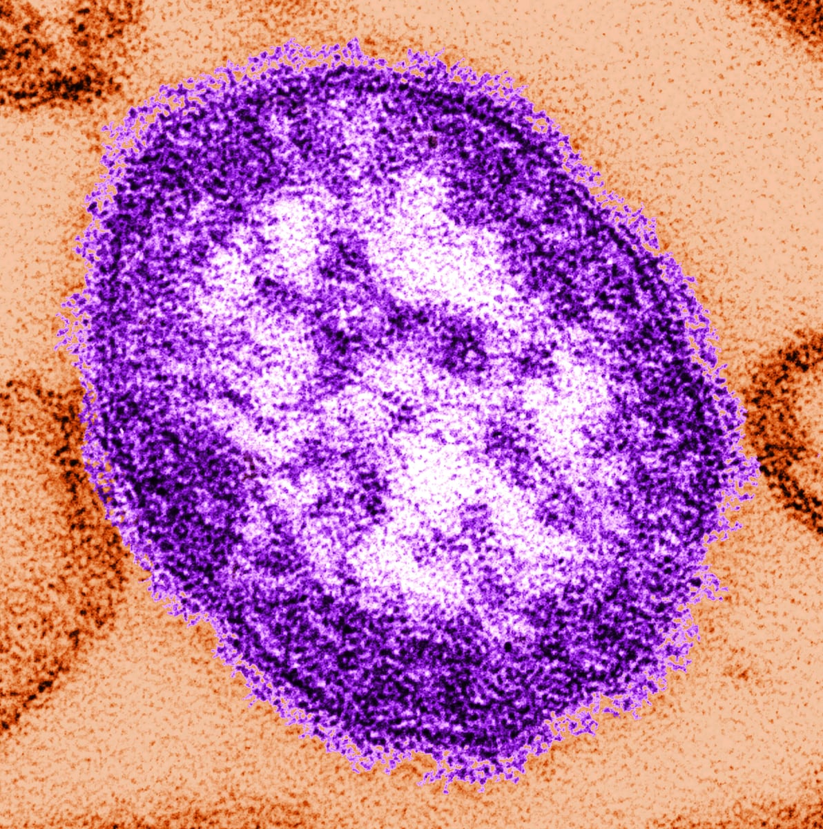 Wayne County reports measles outbreak among unvaccinated
