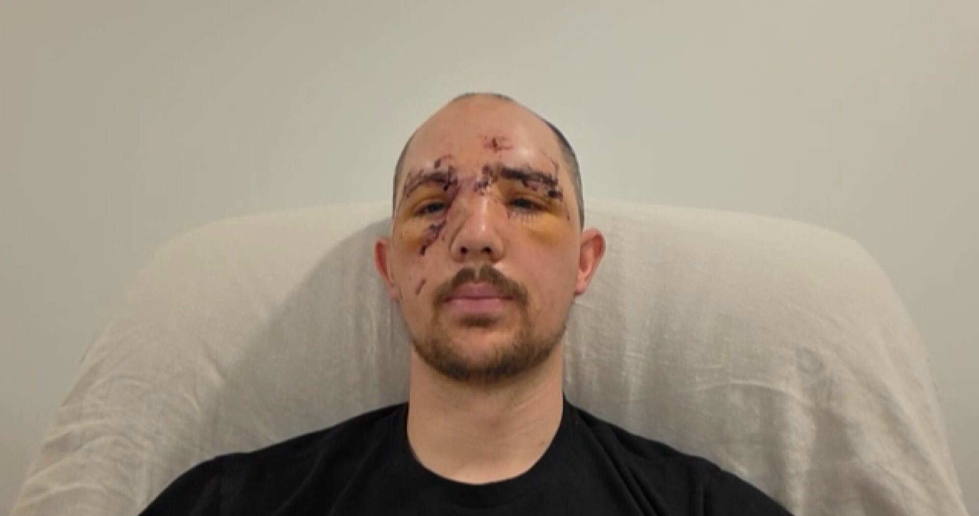 Father bitten in face by bear during hunting trip: ‘I could hear all the bones crunching’