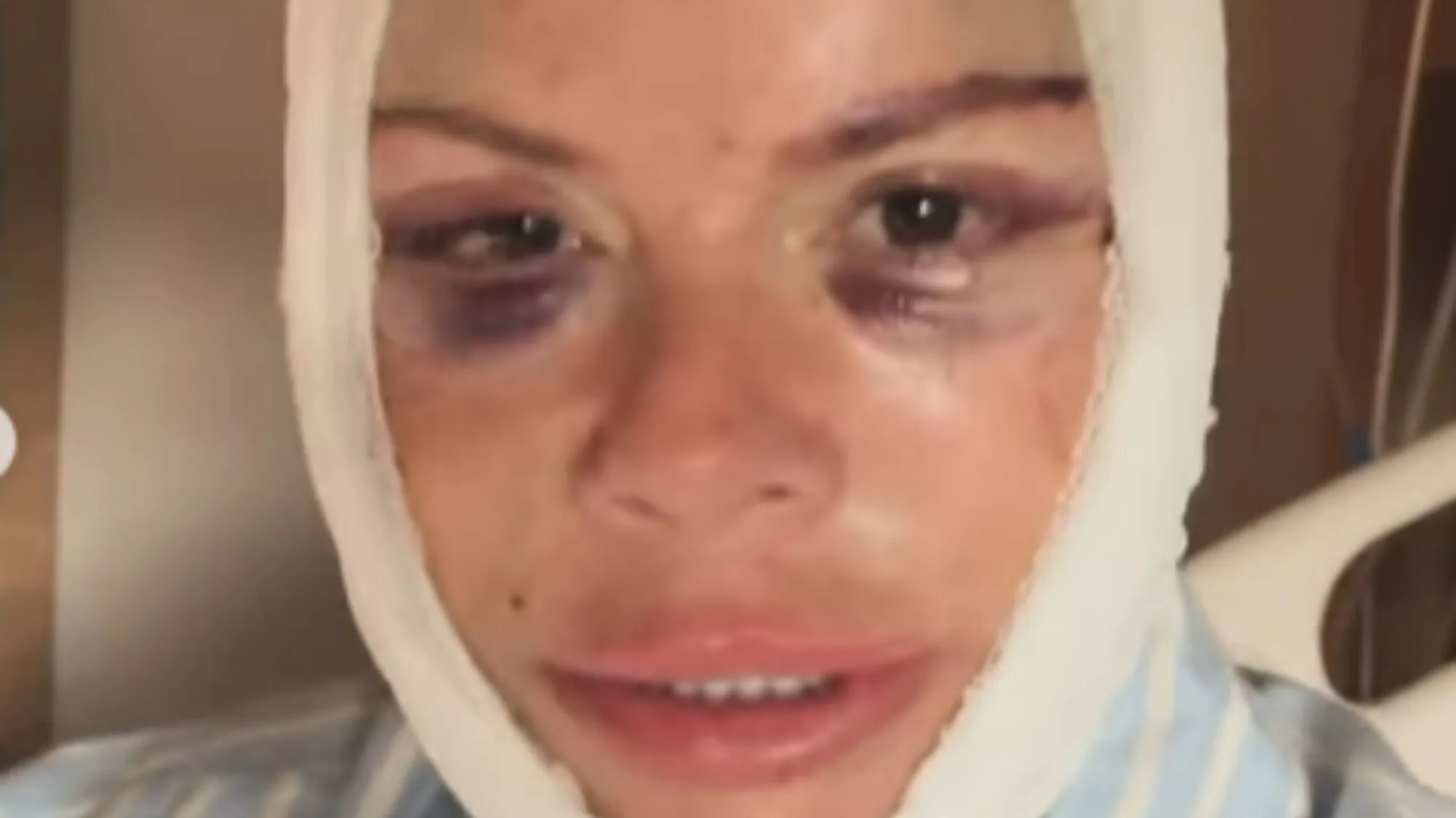 Big Brother star shows off bruised and bandaged face as she unveils results of new facelift