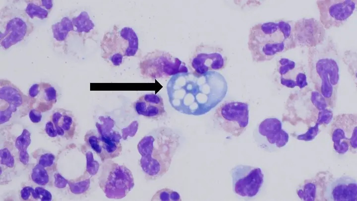 Teen dies from brain-eating amoeba just days after Louisiana child's death