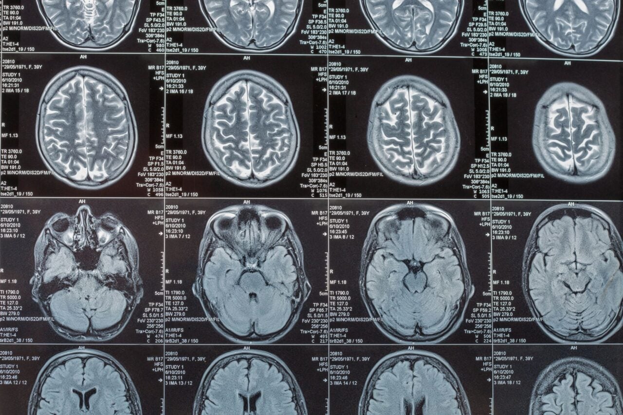 Scientists Say a Key Trigger for Alzheimer’s Damage Isn’t Even in the Brain