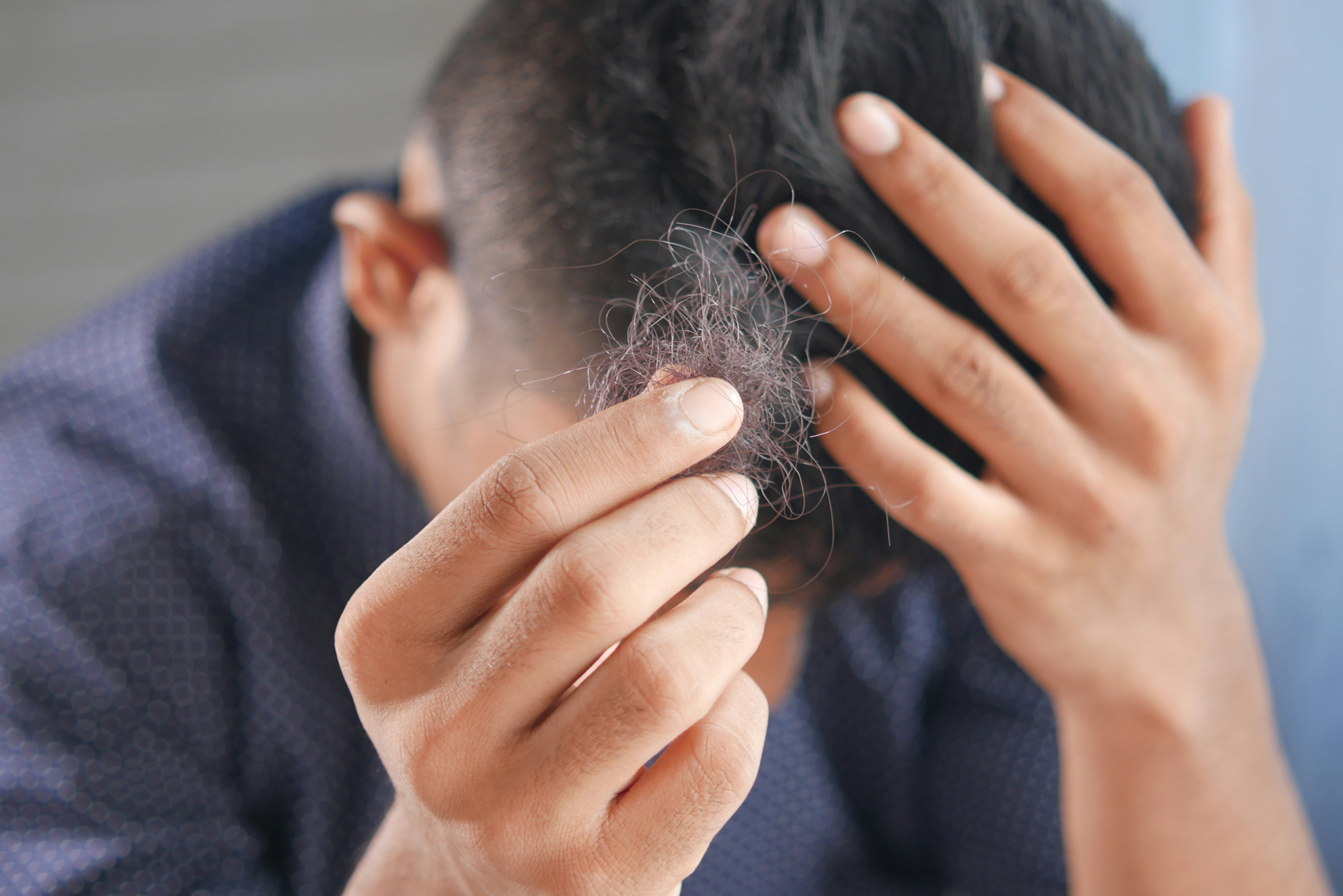 GLP-1 meds cause more hair loss than other drugs used to treat type 2 diabetes, Penn study finds