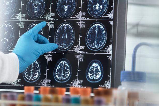 Alzheimer’s drug to be offered to people without symptoms to stop it developing
