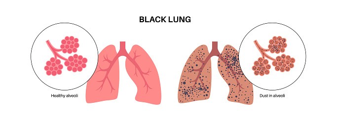 Black lung disease is rising again among Appalachian coal miners