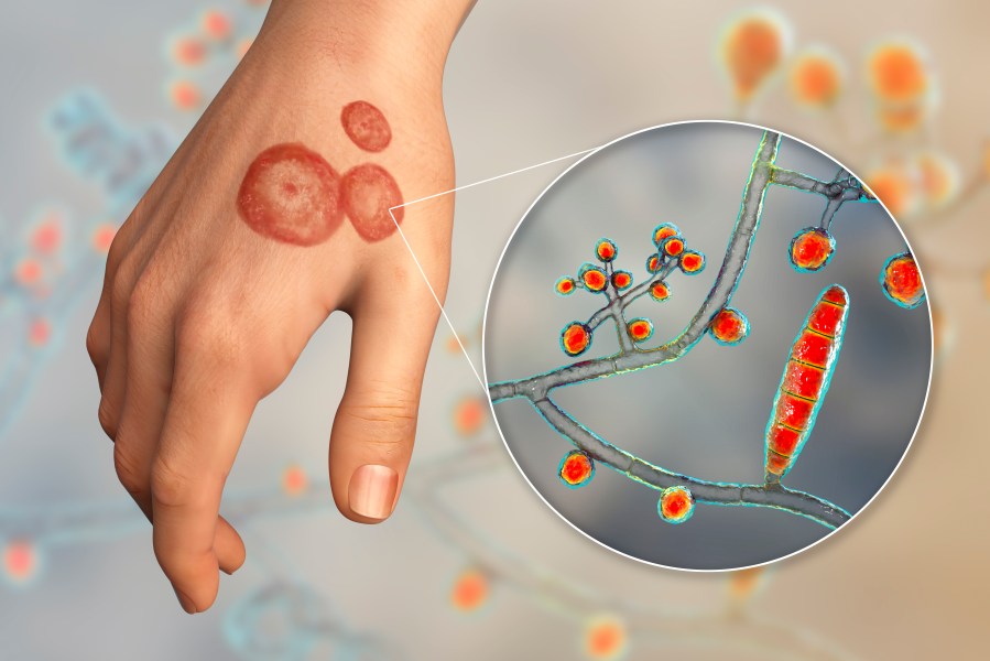 Drug-resistant ringworm fungus has spread to 29 countries: Study