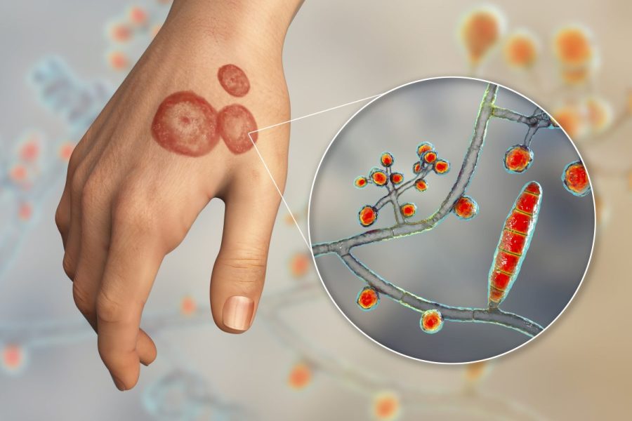 Drug-resistant ringworm fungus has spread to 29 countries: Study