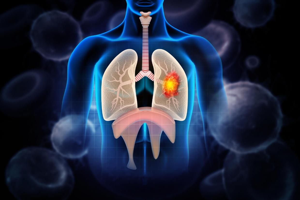 Seoul draws global lung cancer experts for major medical congress