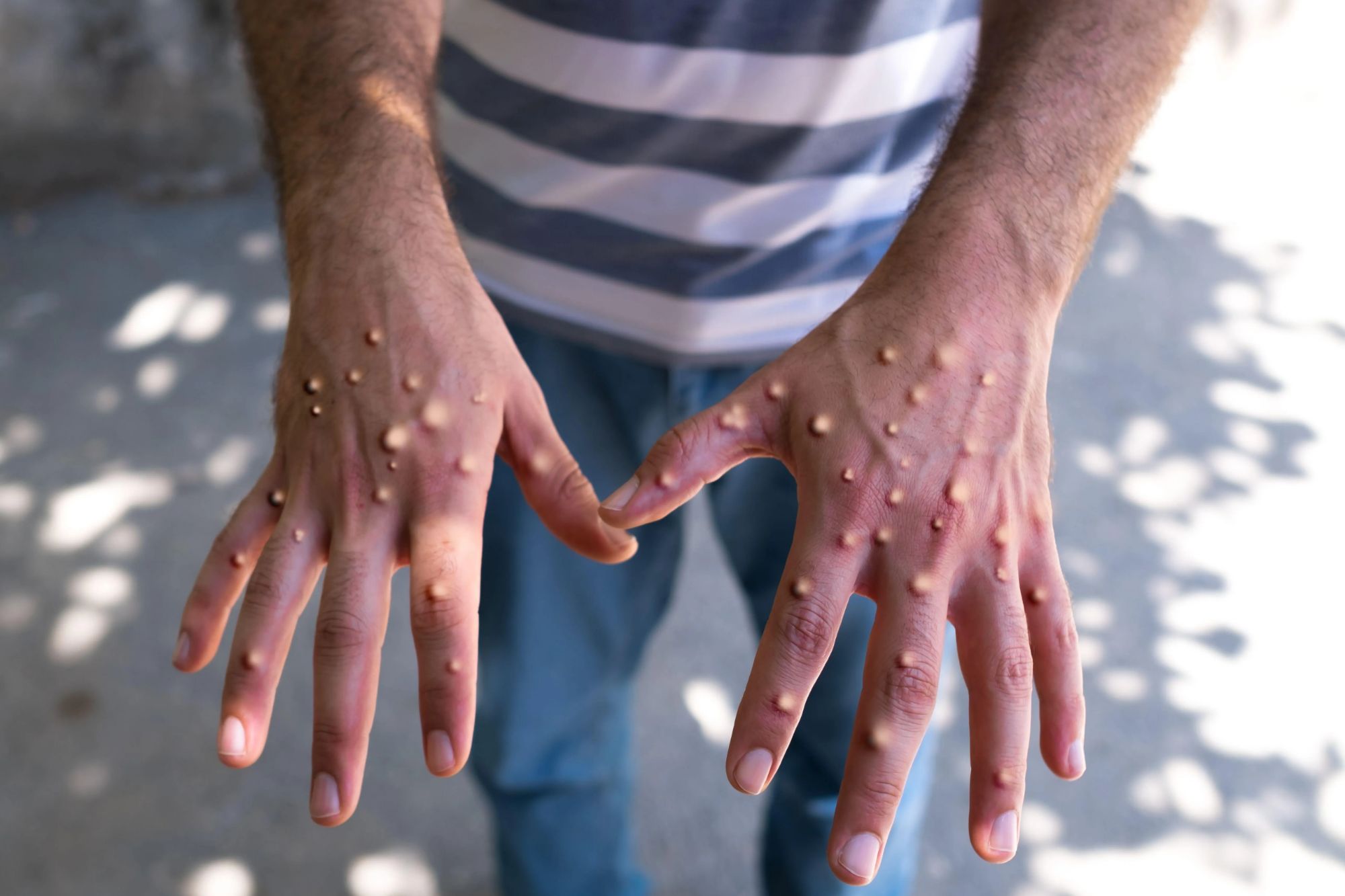 Fears of fresh monkeypox outbreak in Spain as new case confirmed in holiday hotspot