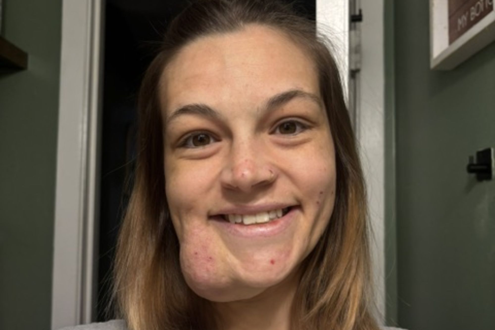 I squeezed a pimple on my face before it grew to a permanent, throbbing growth for 19 years – trolls call me Quagmire