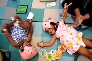 How St. Louis doctors separated conjoined twins. And how they're doing now