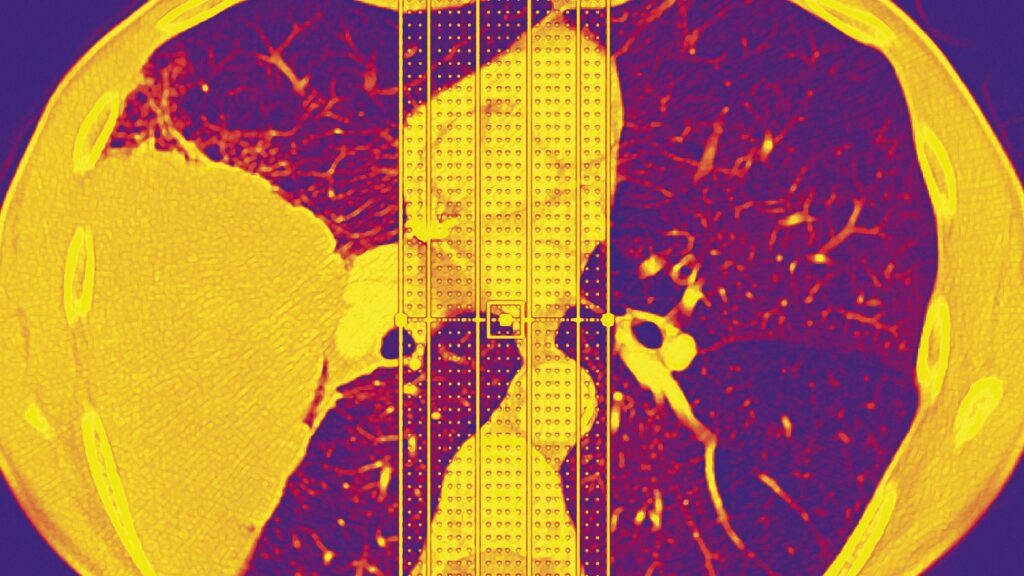 STAT+: Why do ‘never smokers’ get lung cancer? In some cases, rare genetic variant may be a factor