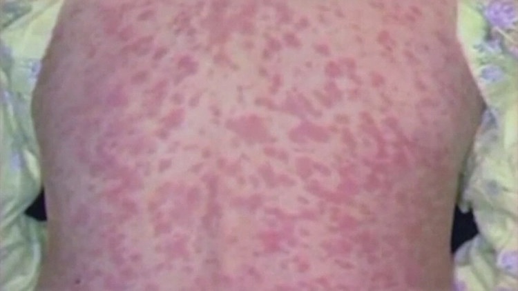 New measles case in Maricopa County, raising total to 28 cases in 2026