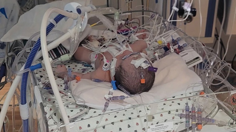 Baby boy undergoes open heart surgery just days after birth