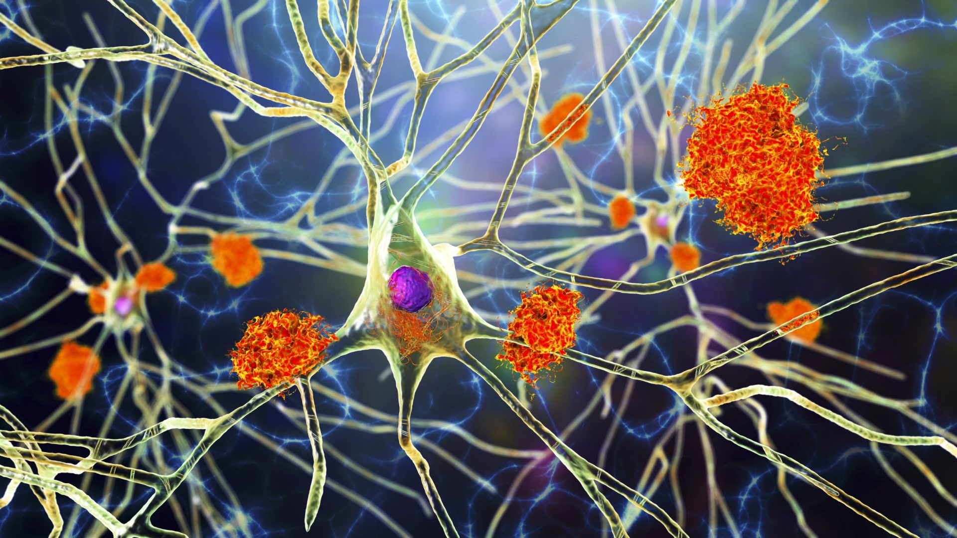 The drugs that could slow Alzheimer’s – and when they could come to NHS