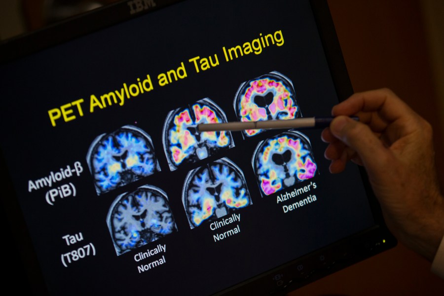 Naturally occurring human peptide shows promise against Alzheimer's