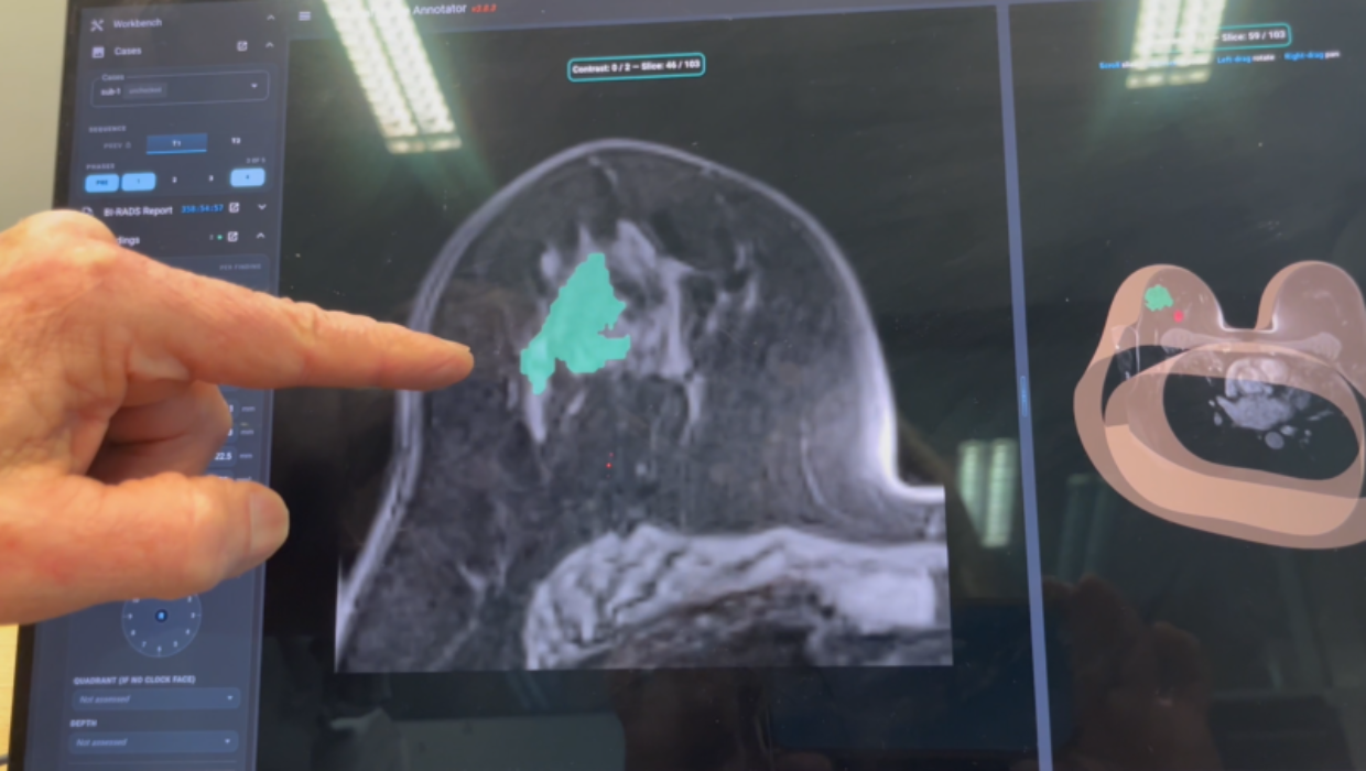 From months to hours: NZ-developed tool aims to end ‘terrifying’ wait for breast cancer answers
