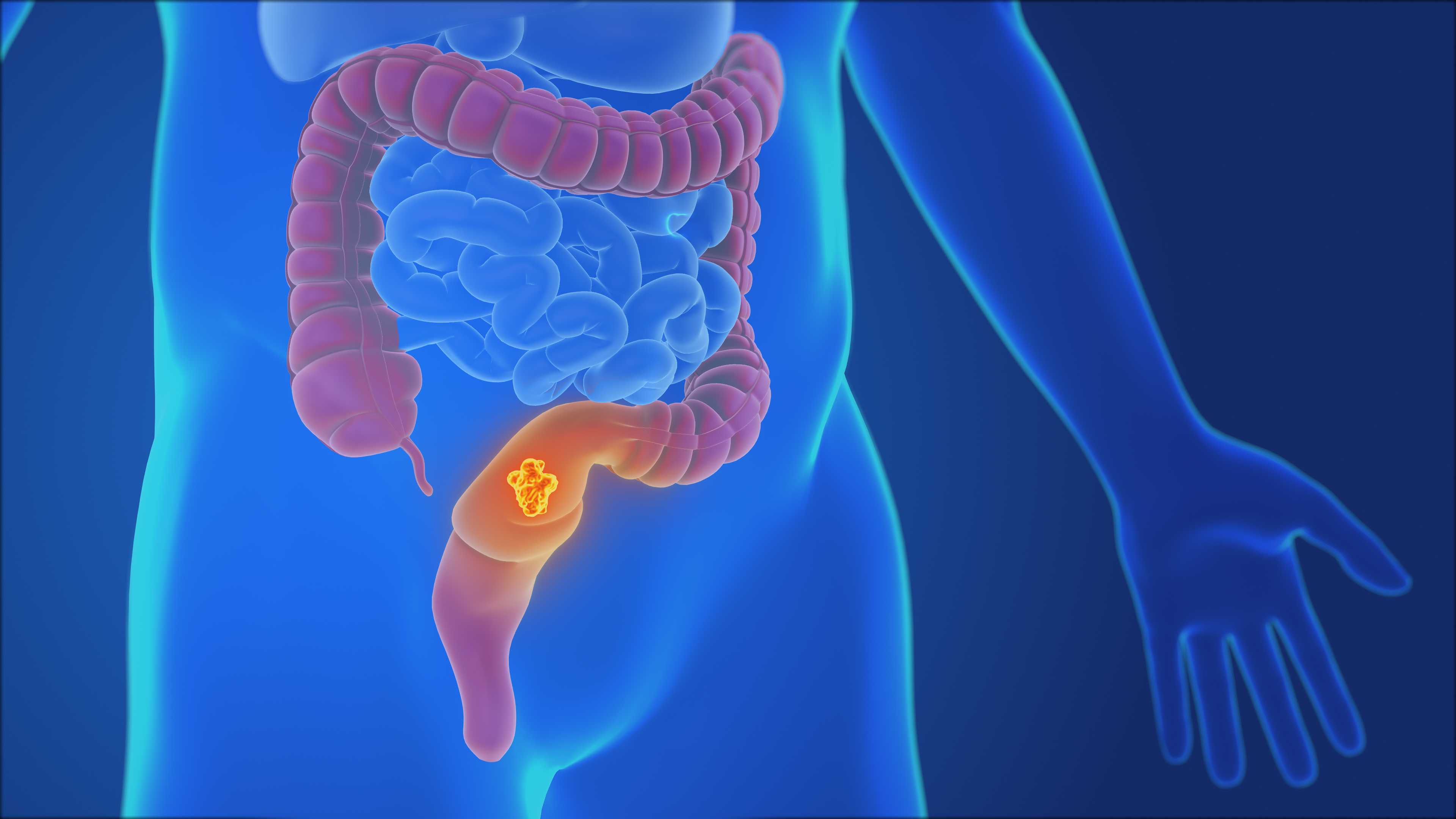 Early detection crucial to detect colorectal cancer in younger patients
