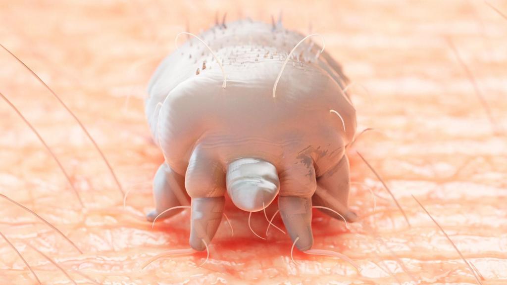 Scabies outbreak at hospital closes wards
