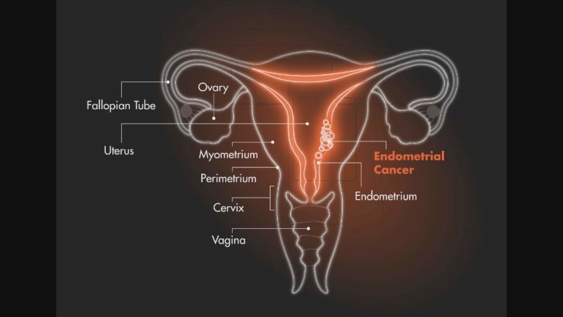 Survivor, doctor warn of rising endometrial cancer rates among younger women