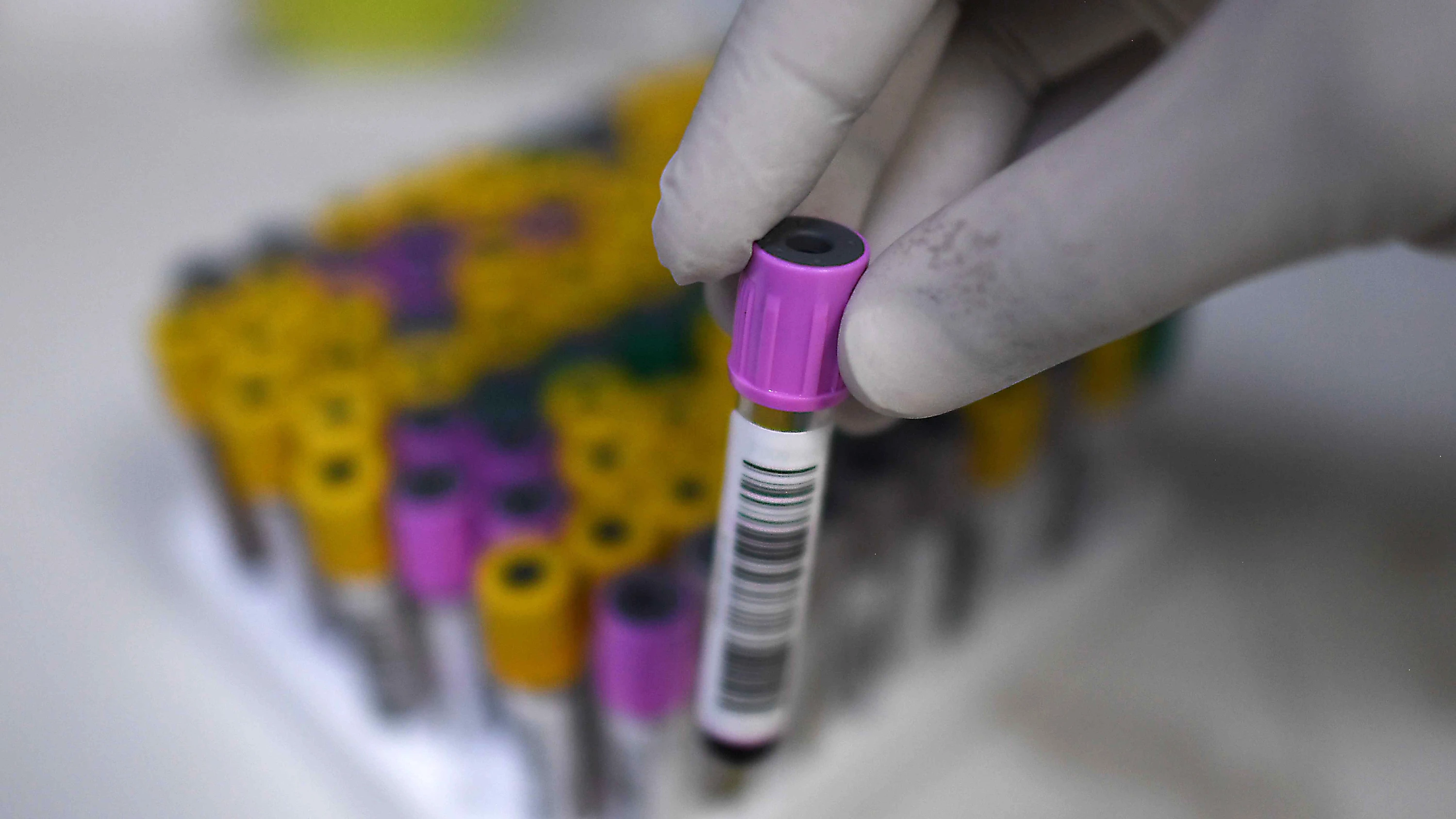 USA unter Trump: UN warnen vor Aufflammen der HIV-Epidemie – US-Zahlungen deutlich zurückgegangen