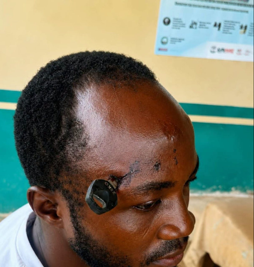 Doctors successfully remove motorbike key from farmer’s skull after Jasikan attack