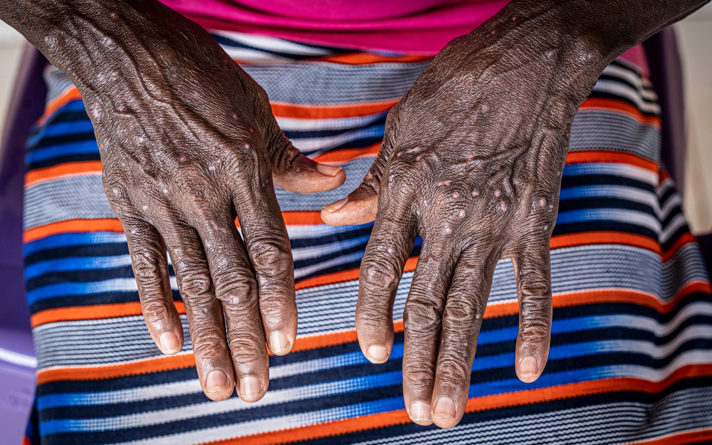 Explosive mpox outbreak causes 3,000 cases in Madagascar
