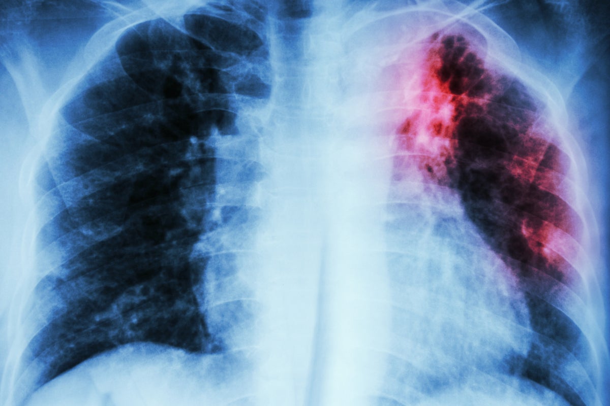 Almost one person every week diagnosed with tuberculosis after death in England