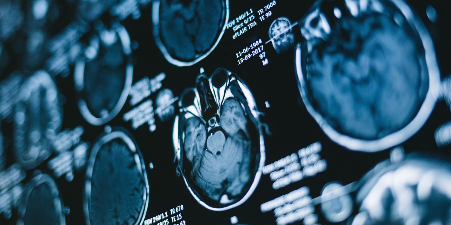 Researchers find evidence connecting a specific blood protein to brain tissue loss