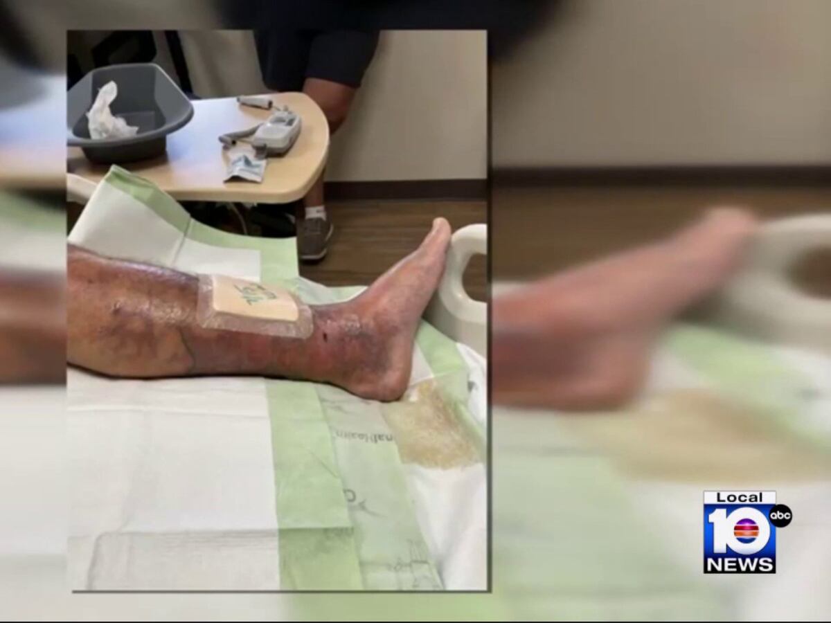 ‘Flesh-eating’ bacteria infections in Florida: 1 dead, 12 confirmed cases, health officials report