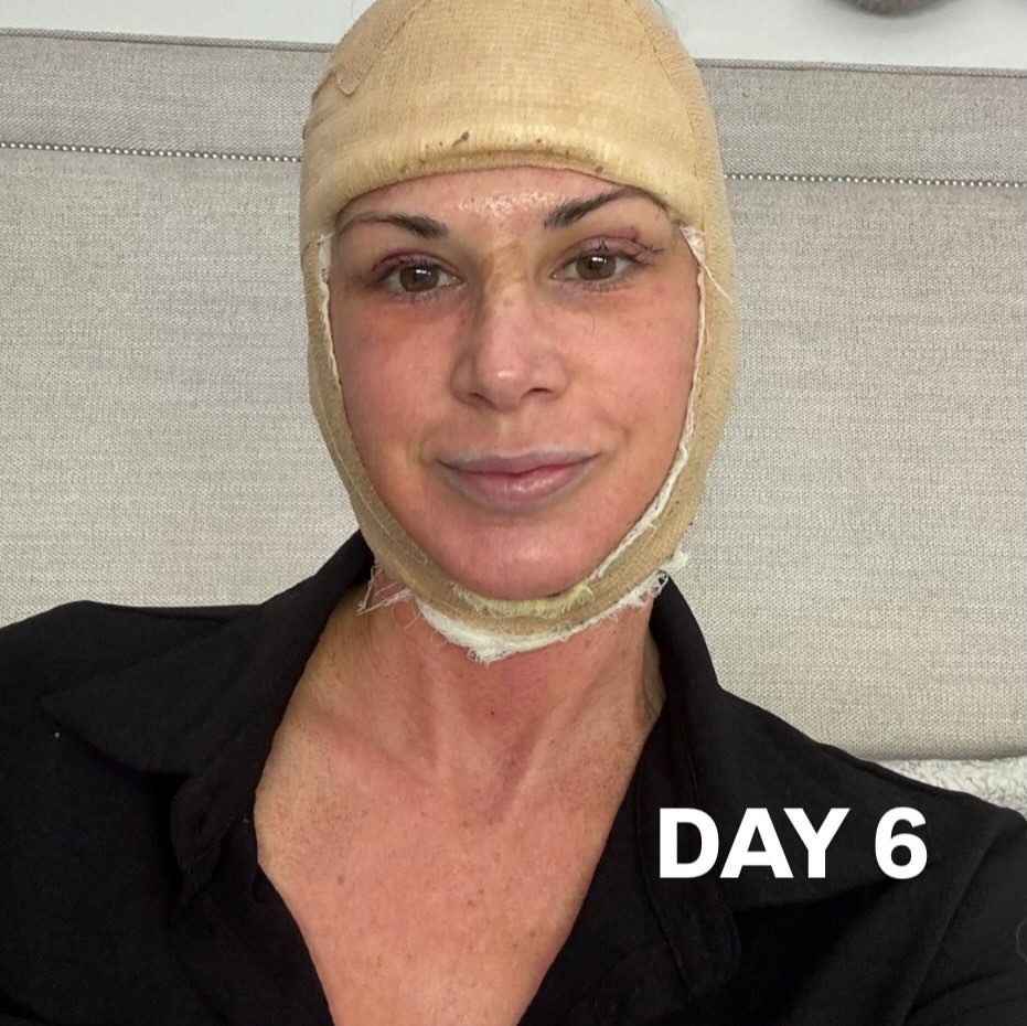 RHOC's Alexis Bellino Reveals Facelift Results, Details 'Brutal' Recovery