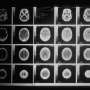 Light-activated nanoparticles could help surgeons find and destroy brain cancer remnants