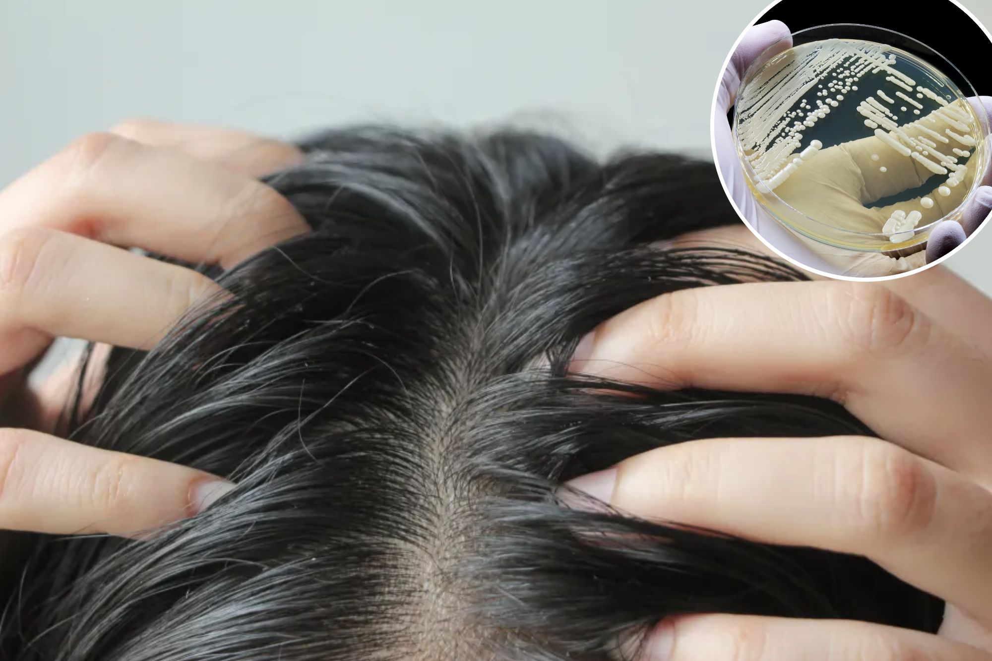 Deadly superbug confirmed in 23 states can hide in your hair follicles — and rewire your immune system