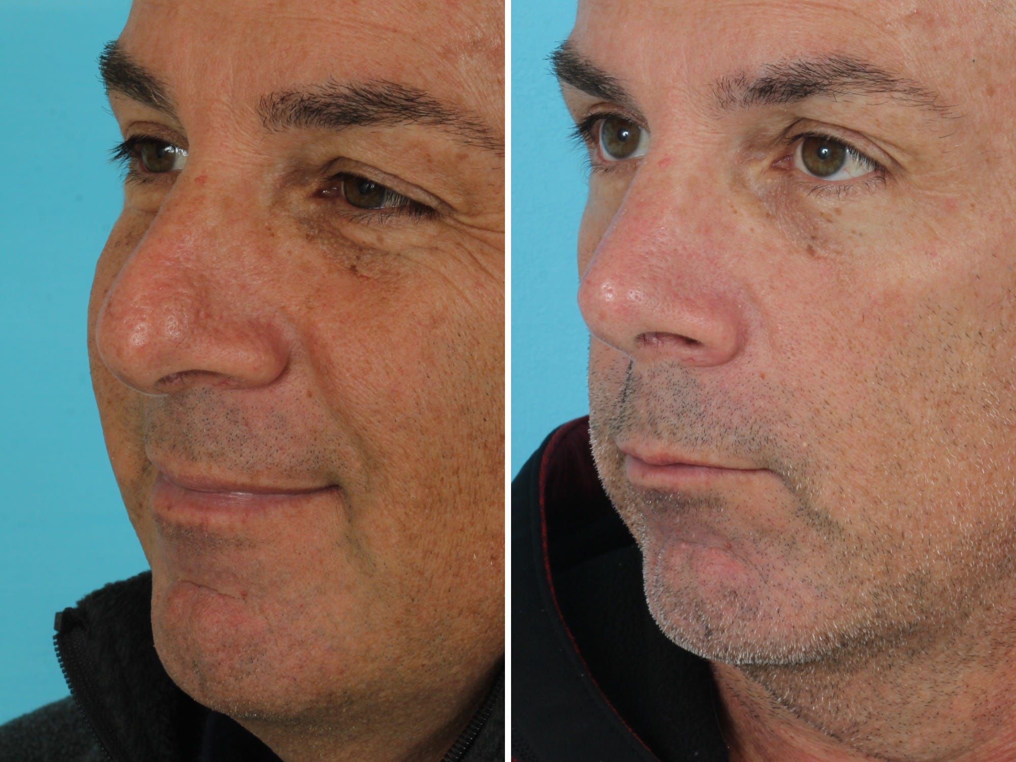 I'm a retired firefighter. I spent $14,000 on plastic surgery in my 50s, and I'm not ashamed.