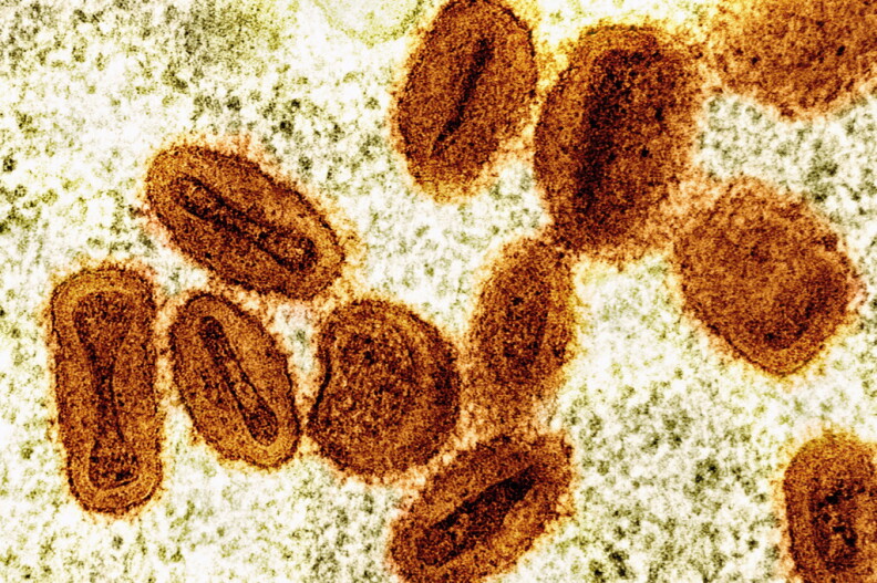 Clade I Mpox case diagnosed in San Diego County after travel abroad