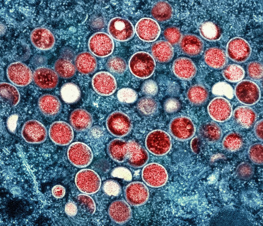 NYC reports rise in Mpox Clade I cases among travelers returning from overseas