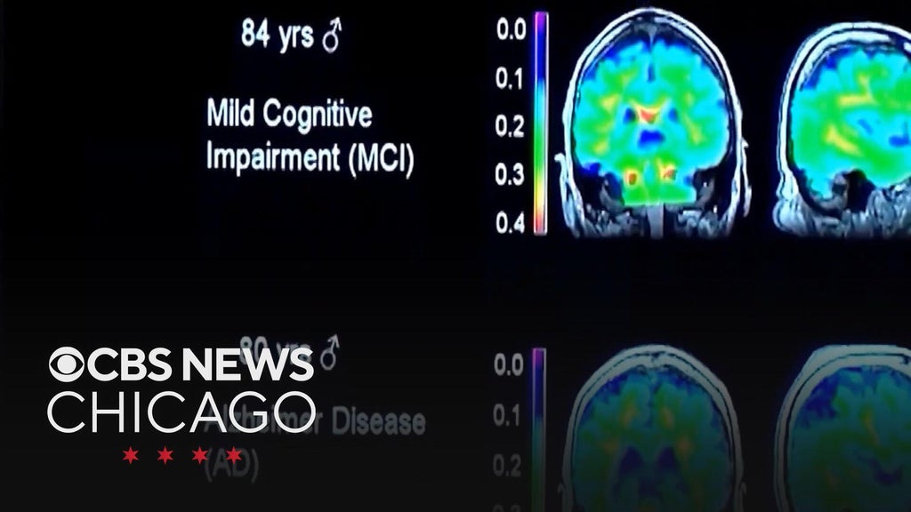 Expert emphasizes how lifestyle and metabolism affect brain health