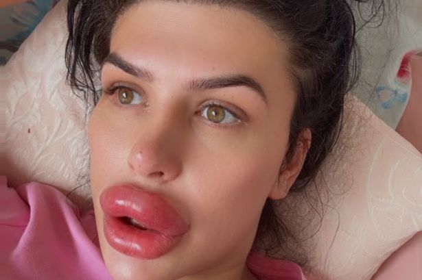 Woman injects ger own lip fillers at home after doctors refused