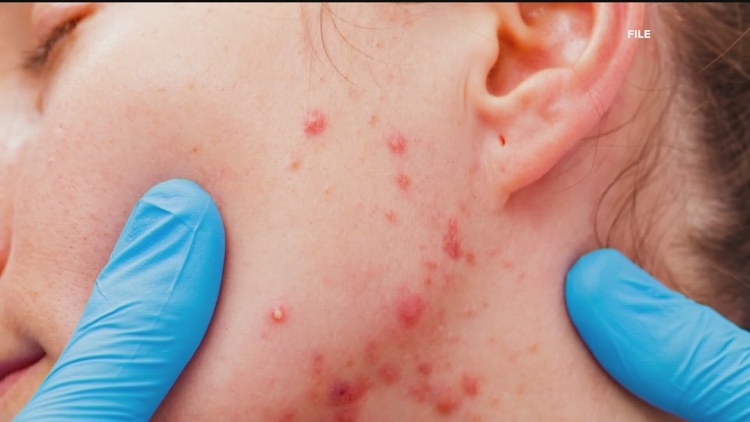 New measles case confirmed in unvaccinated metro Atlanta resident | What to know