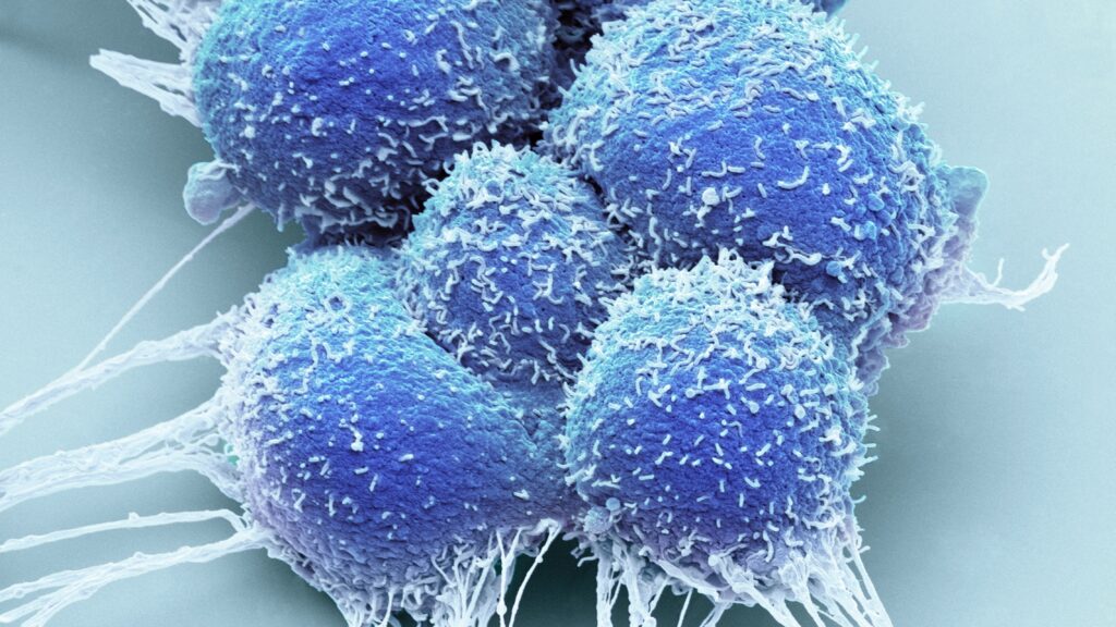 Focal therapy for localized prostate cancer has divided physicians. Will new data change minds?