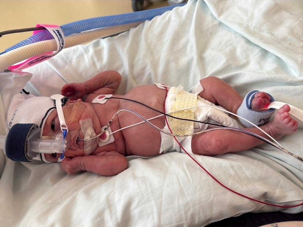 Baby born at 12.5 ounces graduates NICU after 375 days in the hospital