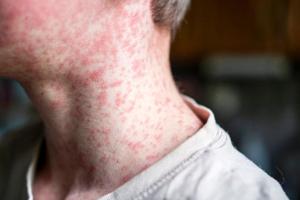 48 measles cases now tied to outbreak in southwest Wisconsin